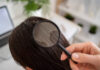 Dandruff