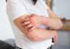 eczema