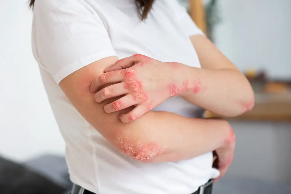 eczema