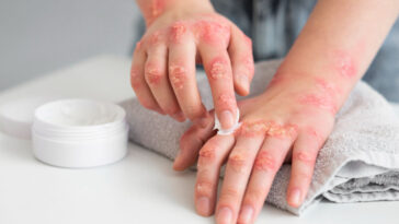 Scabies home treatment