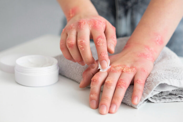 Scabies home treatment