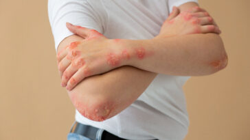 Why does scabies occur?