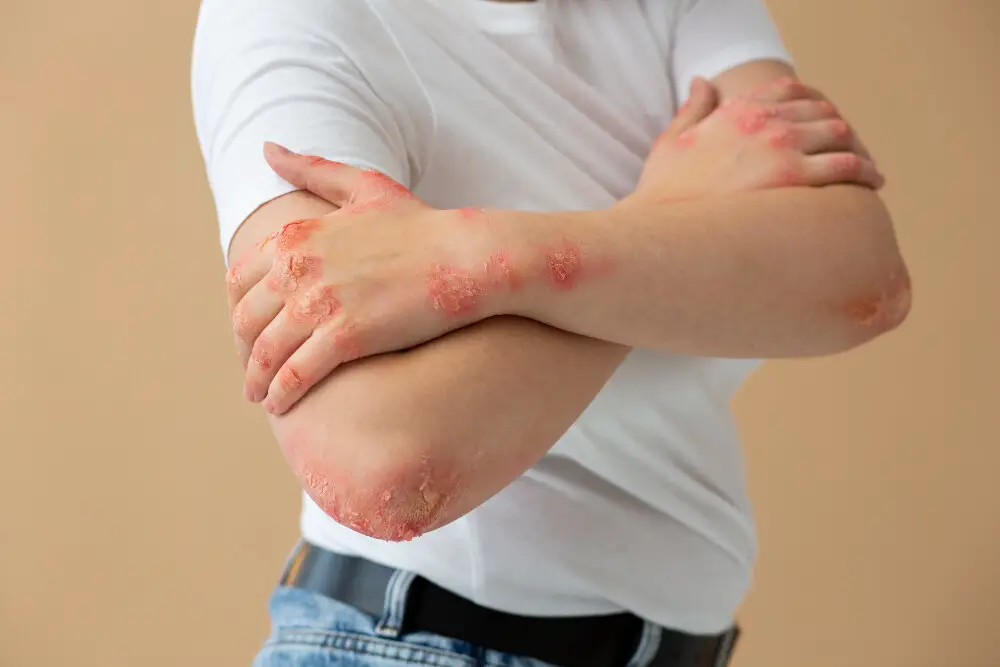 Why does scabies occur?