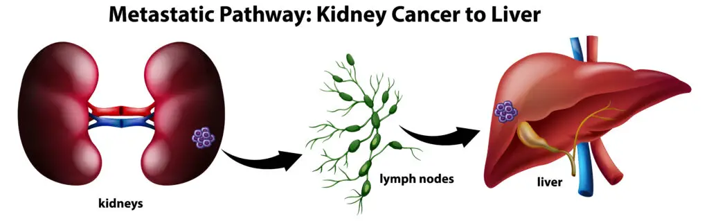 Signs of death in liver cancer patients