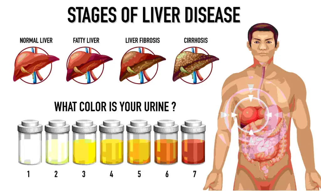 Symptoms of fatty liver disease