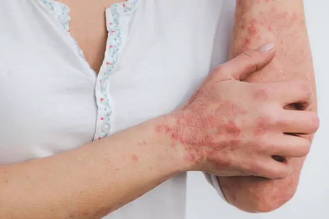 What causes skin disease