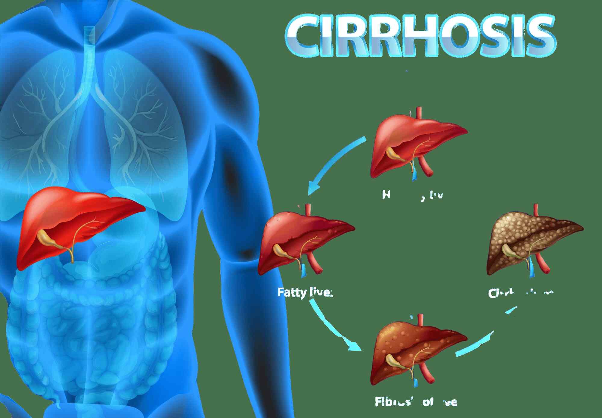 Liver Cirrhosis patients live for how long