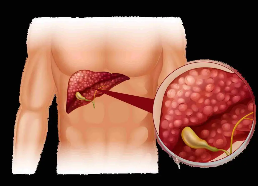 Symptoms of fatty liver disease