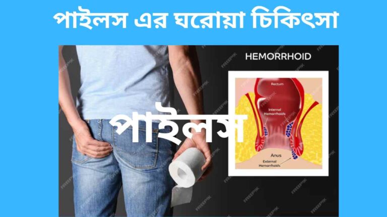 পাইলস-এর-ঘরোয়া-চিকিৎসা