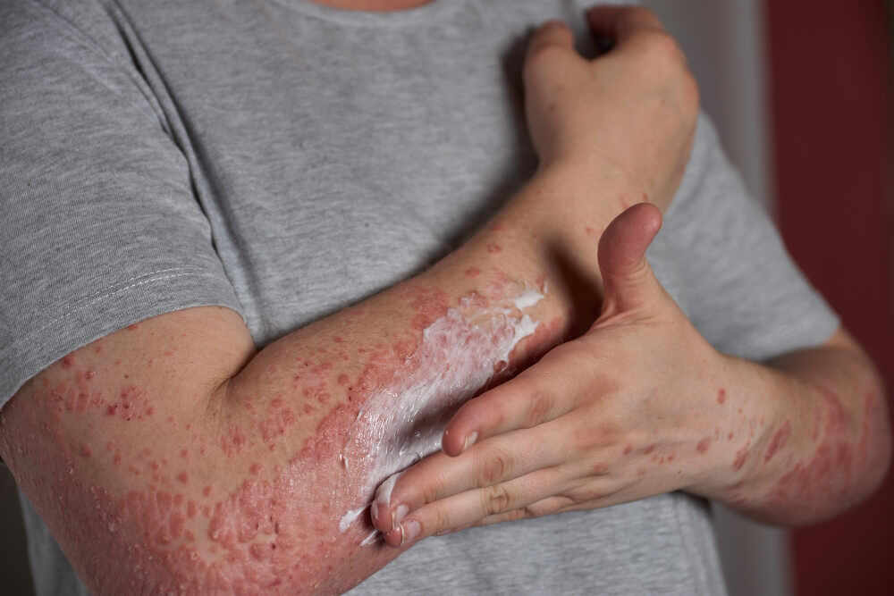 Ways-to-Get-Rid-of-Allergies